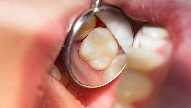 tooth with metal free restorations