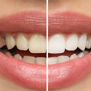 Patient's smile before and after teeth whitening