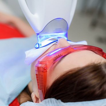 In-office teeth whitening treatment