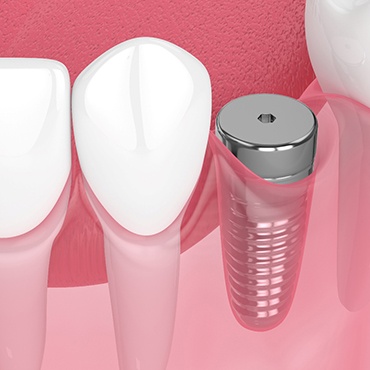 Digital illustration of a dental implant