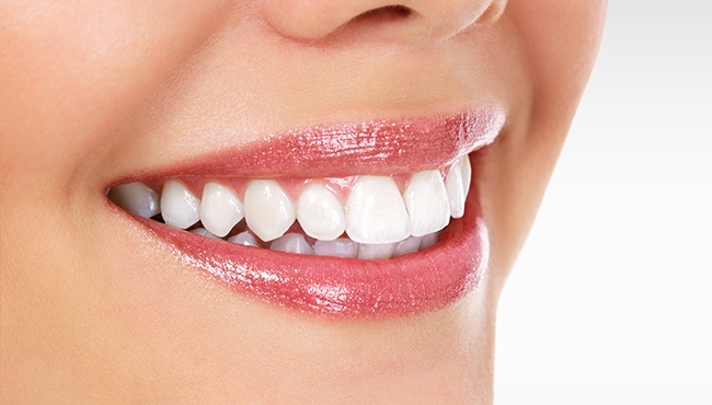 close up of veneers on womans smile