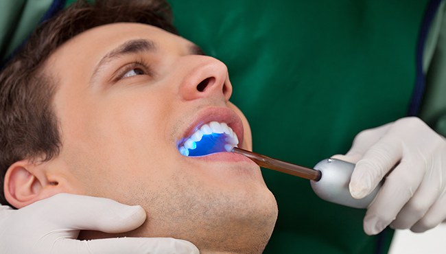 man having tooth colored fillings done