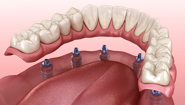 Illustration of implant dentures for lower dental arch