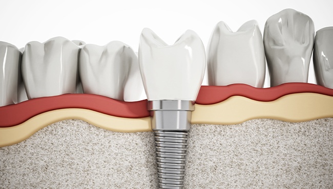 computer illustration of implant in bone