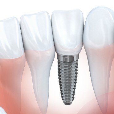 single implant