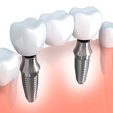 multiple missing teeth implants
