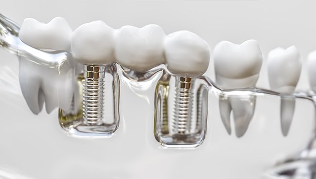 mock up of dental bridge in clear gums