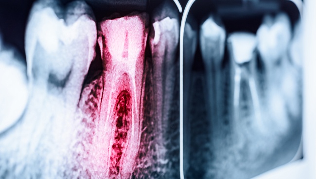 red tooth on x-rays