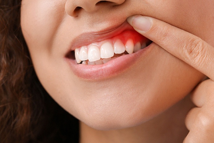 a person pointing to red and swollen gums