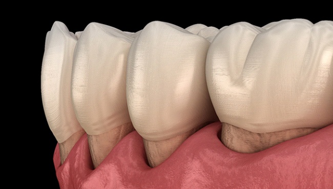 a computer illustration of gum recession