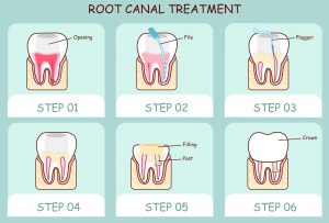 Root canal therapy from dentist in Buffalo Grove, Dr. Natalya Nagornaya, heals failing teeth. Read the backstory of this tried and true restoration.