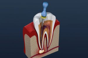 diagram of a root canal