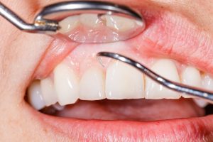 dental cleaning