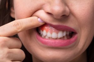 a woman showing her inflamed gums