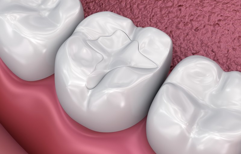 A 3D illustration of dental fillings